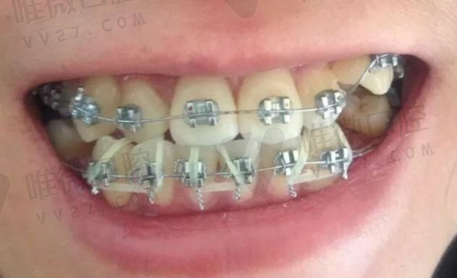 镶牙的优点和缺点（镶牙和种牙的好处和坏处）(图1)
